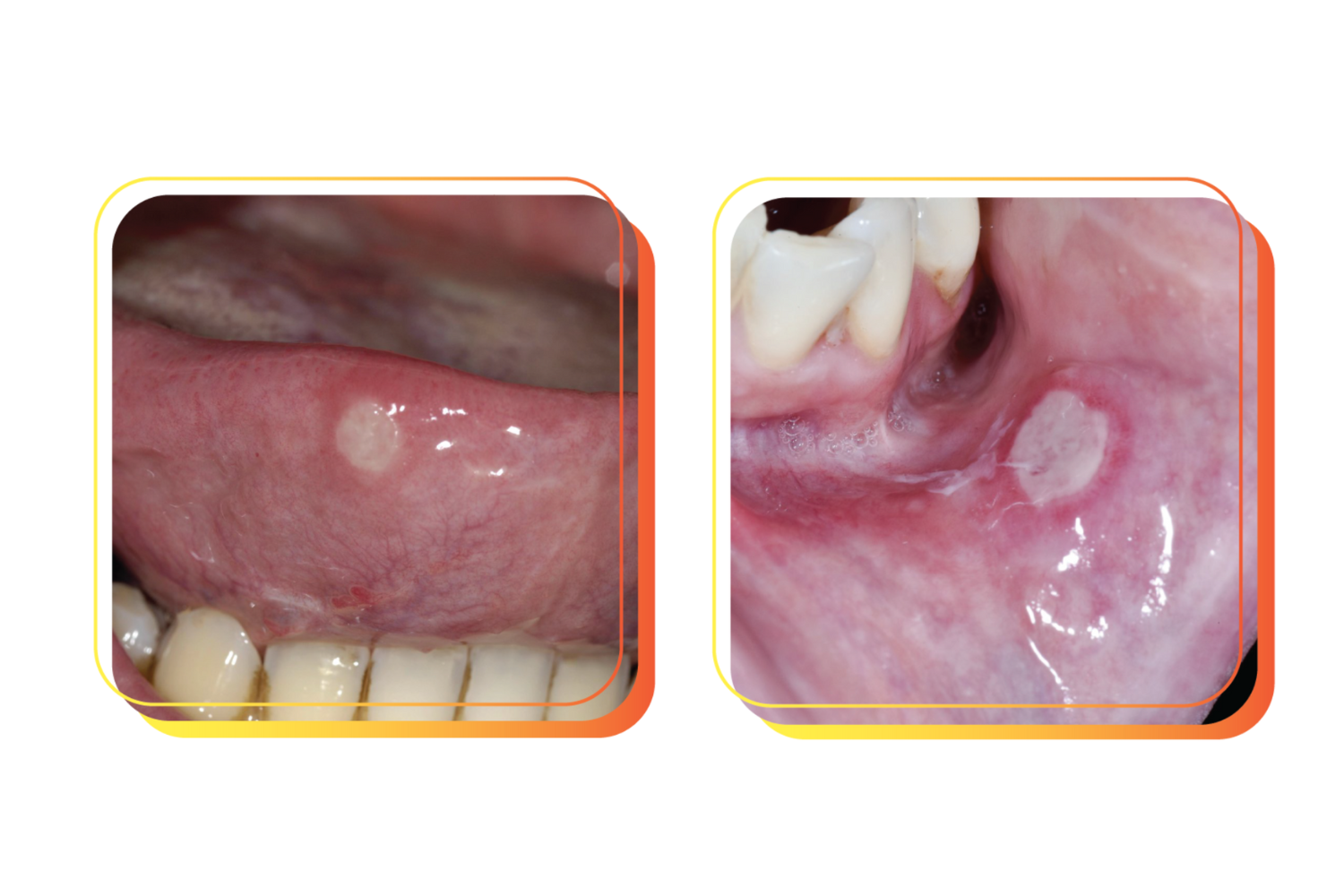 Ulcer Remedy Ulcer Remedy